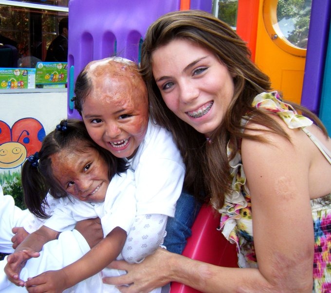 Fundación Michou y Mau: salvando vidas de niños con quemaduras graves