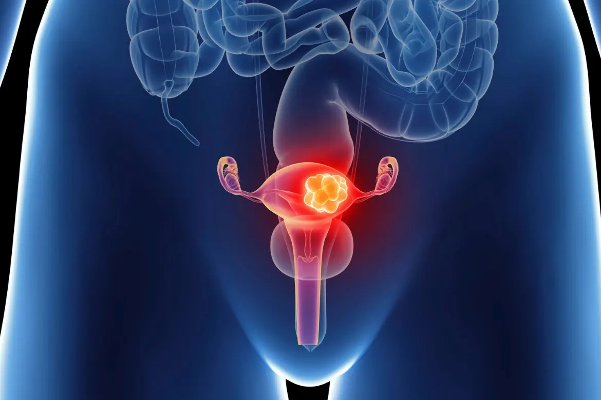 El cáncer de ovario representa una de las neoplasias ginecológicas más agresivas