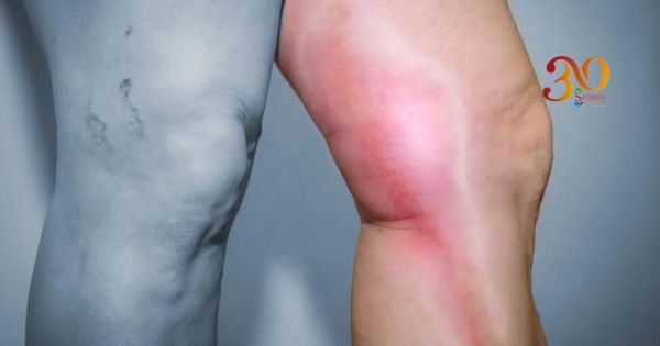 Trombosis: una amenaza silenciosa