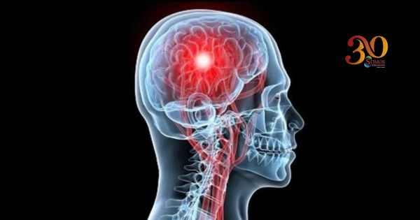 Accidente cerebrovascular: reconocer las señales y actuar rápido puede salvar una vida